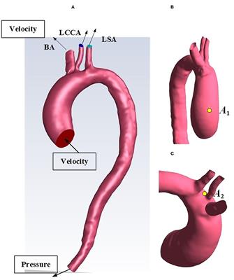 Effects of a Short-Term Left Ventricular Assist Device on Hemodynamics in a Heart Failure Patient-Specific Aorta Model: A CFD Study